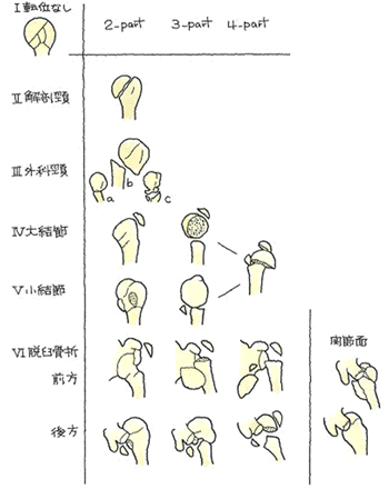 腕骨 外科 骨折 上 頚